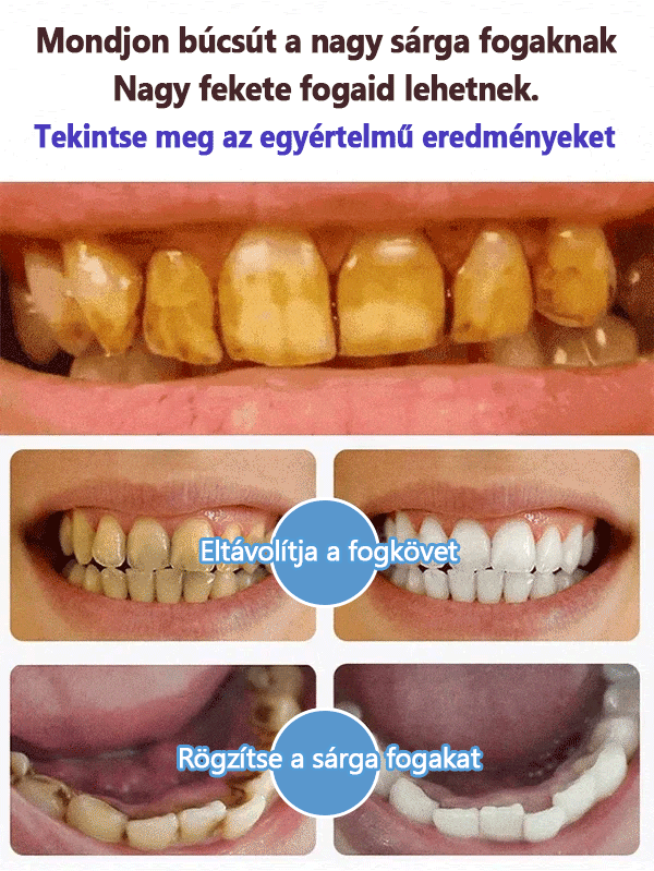 💥Super Probiotic-4 fogkrém 6 probiotikummal oalance Oral mikrobióta erőssége